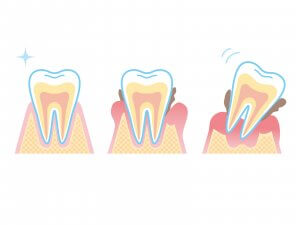 ５０代女性の８割が歯周病　糖尿病・動脈硬化・認知症　予防歯科